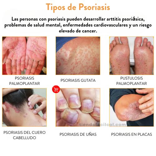 SPRAY ALIVIO PSORIASIS