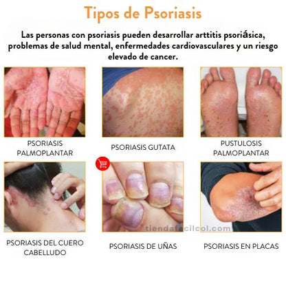 SPRAY ALIVIO PSORIASIS