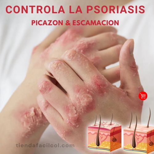 SPRAY ALIVIO PSORIASIS
