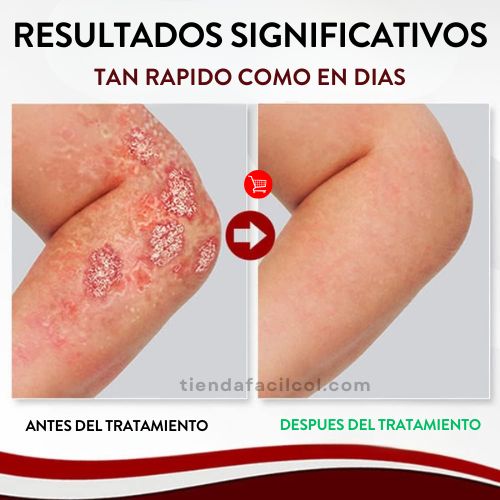 SPRAY ALIVIO PSORIASIS