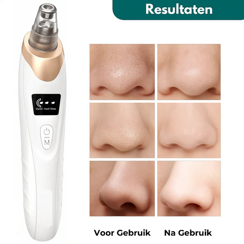 Extractor De Puntos Negros Y Espinillas