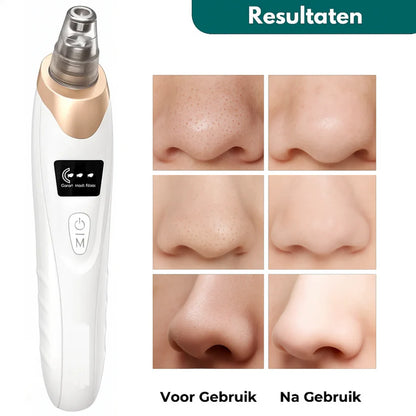 Extractor De Puntos Negros Y Espinillas