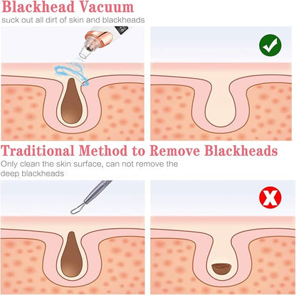 Extractor De Puntos Negros Y Espinillas