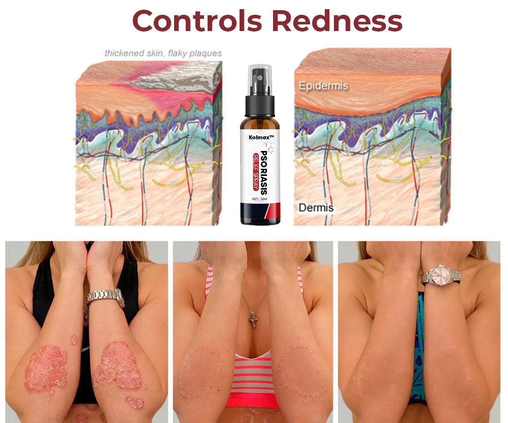 SPRAY ALIVIO PSORIASIS